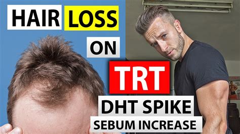 how to avoid hair loss on trt